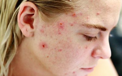 Acne behandelingen